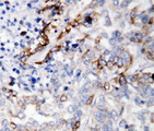 LAMC2 / Laminin Gamma 2 Antibody - LAMC2 / Laminin Gamma 2 antibody. IHC(P): Human Lung Cancer Tissue.