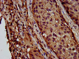 LAPTM4B Antibody - Immunohistochemistry image at a dilution of 1:600 and staining in paraffin-embedded human lung cancer performed on a Leica BondTM system. After dewaxing and hydration, antigen retrieval was mediated by high pressure in a citrate buffer (pH 6.0) . Section was blocked with 10% normal goat serum 30min at RT. Then primary antibody (1% BSA) was incubated at 4 °C overnight. The primary is detected by a biotinylated secondary antibody and visualized using an HRP conjugated SP system.