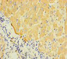 LAPTM5 Antibody - Immunohistochemistry of paraffin-embedded human liver cancer using LAPTM5 Antibody at dilution of 1:100