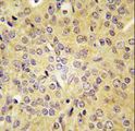 LARS / Leucyl-TRNA Synthetase Antibody - Formalin-fixed and paraffin-embedded human prostate carcinoma tissue reacted with LARS antibody , which was peroxidase-conjugated to the secondary antibody, followed by DAB staining. This data demonstrates the use of this antibody for immunohistochemistry; clinical relevance has not been evaluated.