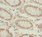 LARS2 / LEURS1 Antibody - Immunohistochemistry of paraffin-embedded human colon cancer at dilution 1:100