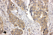 LASP1 Antibody - LASP1 antibody. IHC(P): Human Lung Cancer Tissue.