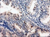 Latexin / MUM Antibody - IHC of paraffin-embedded Adenocarcinoma of Human endometrium tissue using anti-LXN mouse monoclonal antibody.