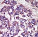 LATS1 Antibody - Formalin-fixed and paraffin-embedded human cancer tissue reacted with the primary antibody, which was peroxidase-conjugated to the secondary antibody, followed by AEC staining. This data demonstrates the use of this antibody for immunohistochemistry; clinical relevance has not been evaluated. BC = breast carcinoma; HC = hepatocarcinoma.
