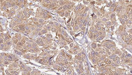 LCN6 Antibody - 1:100 staining human Melanoma tissue by IHC-P. The sample was formaldehyde fixed and a heat mediated antigen retrieval step in citrate buffer was performed. The sample was then blocked and incubated with the antibody for 1.5 hours at 22°C. An HRP conjugated goat anti-rabbit antibody was used as the secondary.