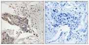 LCP2 / SLP-76 Antibody - Immunohistochemistry analysis of paraffin-embedded human breast carcinoma tissue, using SLP-76 Antibody. The picture on the right is blocked with the synthesized peptide.
