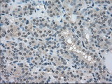 LDHA / LDH1 Antibody - IHC of paraffin-embedded Carcinoma of thyroid tissue using anti-LDHA mouse monoclonal antibody. (Dilution 1:50).