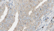 LDHB / Lactate Dehydrogenase B Antibody - 1:100 staining human prostate tissue by IHC-P. The sample was formaldehyde fixed and a heat mediated antigen retrieval step in citrate buffer was performed. The sample was then blocked and incubated with the antibody for 1.5 hours at 22°C. An HRP conjugated goat anti-rabbit antibody was used as the secondary.