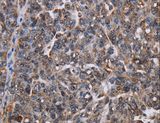 LDOC1 Antibody - Immunohistochemistry of paraffin-embedded Human ovarian cancer using LDOC1 Polyclonal Antibody at dilution of 1:50.