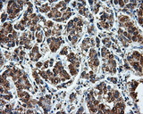 LEMD3 / MAN1 Antibody - IHC of paraffin-embedded Carcinoma of liver tissue using anti-LEMD3 mouse monoclonal antibody. (Dilution 1:50).