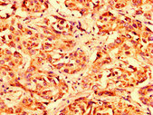 LETM1 Antibody - Immunohistochemistry image at a dilution of 1:300 and staining in paraffin-embedded human liver cancer performed on a Leica BondTM system. After dewaxing and hydration, antigen retrieval was mediated by high pressure in a citrate buffer (pH 6.0) . Section was blocked with 10% normal goat serum 30min at RT. Then primary antibody (1% BSA) was incubated at 4 °C overnight. The primary is detected by a biotinylated secondary antibody and visualized using an HRP conjugated SP system.