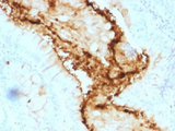 Lewis y / BG8 / CD174 Antibody - IHC testing of FFPE human colon carcinoma with Lewis y antibody (clone A70-A/A9). Required HIER: boil tissue sections in 10mM citrate buffer, pH 6, for 10-20 min.