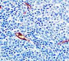 Lewis y / BG8 / CD174 Antibody - IHC of BG8 LewisY an FFPE Lung Adenocarcinoma tissue.
