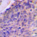 LGALS8 / Galectin 8 Antibody - Immunohistochemical analysis of Galectin 8 staining in human breast cancer formalin fixed paraffin embedded tissue section. The section was pre-treated using heat mediated antigen retrieval with sodium citrate buffer (pH 6.0). The section was then incubated with the antibody at room temperature and detected using an HRP conjugated compact polymer system. DAB was used as the chromogen. The section was then counterstained with hematoxylin and mounted with DPX.