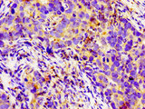 LGR6 Antibody - Immunohistochemistry image of paraffin-embedded human pancreatic cancer at a dilution of 1:100