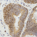 LHB / Luteinizing Hormone Antibody - Immunohistochemistry of paraffin-embedded human rectal cancer tissue using LHB antibody at dilution of 1:200 (x400 lens)