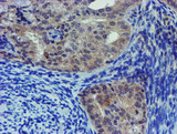 LHX1 Antibody - IHC of paraffin-embedded Adenocarcinoma of Human endometrium tissue using anti-LHX1 mouse monoclonal antibody. (Heat-induced epitope retrieval by 10mM citric buffer, pH6.0, 100C for 10min).