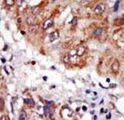 LIMK1 / LIMK Antibody - Formalin-fixed and paraffin-embedded human cancer tissue reacted with the primary antibody, which was peroxidase-conjugated to the secondary antibody, followed by DAB staining. This data demonstrates the use of this antibody for immunohistochemistry; clinical relevance has not been evaluated. BC = breast carcinoma; HC = hepatocarcinoma.