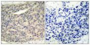LIMK1 / LIMK Antibody - P-Peptide - + Immunohistochemical analysis of paraffin- embedded human breast carcinoma tissue using LIMK1 (phospho-Thr508) antibody.