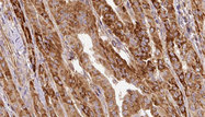 LIPE / HSL Antibody - 1:100 staining human thyroid carcinoma tissue by IHC-P. The sample was formaldehyde fixed and a heat mediated antigen retrieval step in citrate buffer was performed. The sample was then blocked and incubated with the antibody for 1.5 hours at 22°C. An HRP conjugated goat anti-rabbit antibody was used as the secondary.