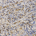 LL37 / Cathelicidin Antibody - Immunohistochemistry of paraffin-embedded human lung cancer using CAMP antibody at dilution of 1:200 (x400 lens)