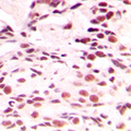 LMNA / Lamin A+C Antibody - Immunohistochemical analysis of Lamin A/C staining in human breast cancer formalin fixed paraffin embedded tissue section. The section was pre-treated using heat mediated antigen retrieval with sodium citrate buffer (pH 6.0). The section was then incubated with the antibody at room temperature and detected using an HRP conjugated compact polymer system. DAB was used as the chromogen. The section was then counterstained with hematoxylin and mounted with DPX.