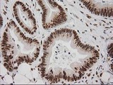 LOX / Lysyl Oxidase Antibody - IHC of paraffin-embedded Adenocarcinoma of Human colon tissue using anti-LOX mouse monoclonal antibody.