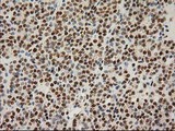 LOX / Lysyl Oxidase Antibody - IHC of paraffin-embedded Carcinoma of Human thyroid tissue using anti-LOX mouse monoclonal antibody.