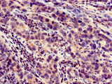LOXHD1 Antibody - Immunohistochemistry of paraffin-embedded human pancreatic cancer using LOXHD1 Antibody at dilution of 1:100