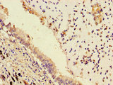 LPP3 / PPAP2B Antibody - Immunohistochemistry of paraffin-embedded human lung cancer using PLPP3 Antibody at dilution of 1:100