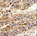 LRG1 / LRG Antibody - Formalin-fixed and paraffin-embedded human lung carcinoma reacted with LRG1 Antibody , which was peroxidase-conjugated to the secondary antibody, followed by DAB staining. This data demonstrates the use of this antibody for immunohistochemistry; clinical relevance has not been evaluated.
