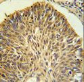 LRG1 / LRG Antibody - LRG1 Antibody IHC of formalin-fixed and paraffin-embedded lung carcinoma followed by peroxidase-conjugated secondary antibody and DAB staining.