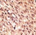 LRP5 Antibody - Formalin-fixed and paraffin-embedded human cancer tissue reacted with the primary antibody, which was peroxidase-conjugated to the secondary antibody, followed by AEC staining. This data demonstrates the use of this antibody for immunohistochemistry; clinical relevance has not been evaluated. BC = breast carcinoma; HC = hepatocarcinoma.