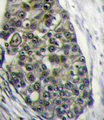 LRP6 Antibody - Formalin-fixed and paraffin-embedded human breast carcinoma tissue reacted with LRP6 Antibody (C-term T1546), which was peroxidase-conjugated to the secondary antibody, followed by DAB staining. This data demonstrates the use of this antibody for immunohistochemistry; clinical relevance has not been evaluated.