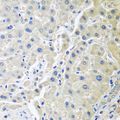 LRP6 Antibody - Immunohistochemistry of paraffin-embedded human gastric cancer using LRP6 antibody at dilution of 1:100 (40x lens).