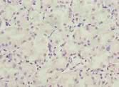 LRRC20 Antibody - Immunohistochemistry of paraffin-embedded human gastric cancer using antibody at dilution of 1:100.