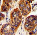 LRRC57 Antibody - LRRC57 Antibody immunohistochemistry of formalin-fixed and paraffin-embedded human bladder carcinoma followed by peroxidase-conjugated secondary antibody and DAB staining.