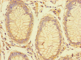 LRRC61 Antibody - Immunohistochemistry of paraffin-embedded human colon cancer using LRRC61 Antibody at dilution of 1:100