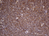 LRRTM1 Antibody - Immunohistochemical staining of paraffin-embedded Human lymphoma tissue using anti-LRRTM1 mouse monoclonal antibody. (Heat-induced epitope retrieval by 1 mM EDTA in 10mM Tris, pH8.5, 120C for 3min,