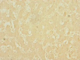 LSD / DNASE1L3 Antibody - Immunohistochemistry of paraffin-embedded human liver cancer using DNASE1L3 Antibody at dilution of 1:100