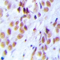 LSM4 Antibody - Immunohistochemical analysis of LSm4 staining in human breast cancer formalin fixed paraffin embedded tissue section. The section was pre-treated using heat mediated antigen retrieval with sodium citrate buffer (pH 6.0). The section was then incubated with the antibody at room temperature and detected using an HRP conjugated compact polymer system. DAB was used as the chromogen. The section was then counterstained with hematoxylin and mounted with DPX.