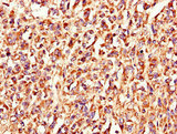 LSMEM1 / C7orf53 Antibody - Immunohistochemistry of paraffin-embedded human melanoma using LSMEM1 Antibody at dilution of 1:100