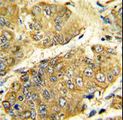 LTA / TNF Beta Antibody - Formalin-fixed and paraffin-embedded human hepatocarcinoma reacted with LTA Antibody , which was peroxidase-conjugated to the secondary antibody, followed by DAB staining. This data demonstrates the use of this antibody for immunohistochemistry; clinical relevance has not been evaluated.