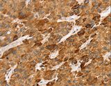 Lymphotoxin-Beta / LTB Antibody - Immunohistochemistry of paraffin-embedded Human liver cancer using LTB Polyclonal Antibody at dilution of 1:45.