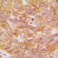 LYN Antibody - Immunohistochemical analysis of LYN staining in human breast cancer formalin fixed paraffin embedded tissue section. The section was pre-treated using heat mediated antigen retrieval with sodium citrate buffer (pH 6.0). The section was then incubated with the antibody at room temperature and detected with HRP and DAB as chromogen. The section was then counterstained with hematoxylin and mounted with DPX.