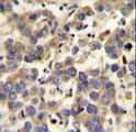 LYPD4 Antibody - LYPD4 antibody immunohistochemistry of formalin-fixed and paraffin-embedded human testis carcinoma followed by peroxidase-conjugated secondary antibody and DAB staining.