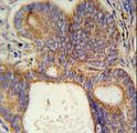 LYSMD1 Antibody - LYSMD1 Antibody immunohistochemistry of formalin-fixed and paraffin-embedded human prostate carcinoma followed by peroxidase-conjugated secondary antibody and DAB staining.