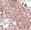 LYVE1 Antibody - Formalin-fixed and paraffin-embedded human cancer tissue reacted with the primary antibody, which was peroxidase-conjugated to the secondary antibody, followed by DAB staining. This data demonstrates the use of this antibody for immunohistochemistry; clinical relevance has not been evaluated. BC = breast carcinoma; HC = hepatocarcinoma.