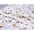 LYZ / Lysozyme Antibody - Lysozyme antibody IHC-paraffin. IHC(P): Human Intestinal Cancer Tissue.