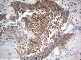 MAATS1 Antibody - IHC of paraffin-embedded Carcinoma of Human lung tissue using anti-C3orf15 mouse monoclonal antibody. (Heat-induced epitope retrieval by 10mM citric buffer, pH6.0, 120°C for 3min).